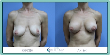 Before and After Gallery - 12